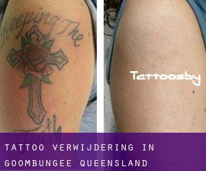 Tattoo verwijdering in Goombungee (Queensland)