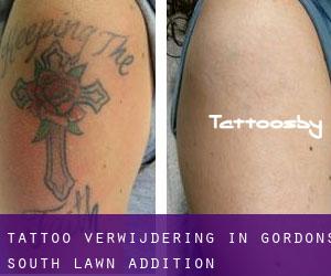 Tattoo verwijdering in Gordons South Lawn Addition
