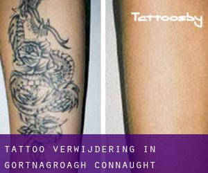 Tattoo verwijdering in Gortnagroagh (Connaught)