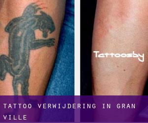 Tattoo verwijdering in Gran-ville
