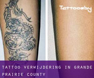Tattoo verwijdering in Grande Prairie County