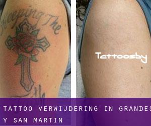 Tattoo verwijdering in Grandes y San Martín