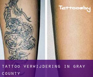Tattoo verwijdering in Gray County