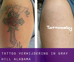 Tattoo verwijdering in Gray Hill (Alabama)