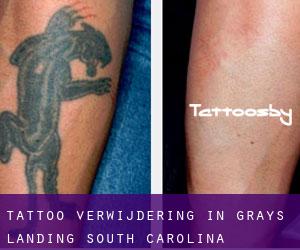 Tattoo verwijdering in Grays Landing (South Carolina)