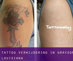 Tattoo verwijdering in Grayson (Louisiana)