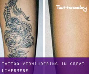Tattoo verwijdering in Great Livermere