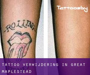 Tattoo verwijdering in Great Maplestead