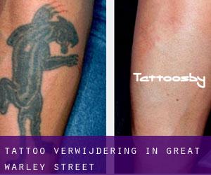 Tattoo verwijdering in Great Warley Street