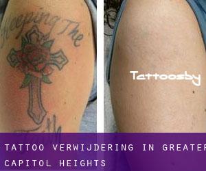 Tattoo verwijdering in Greater Capitol Heights