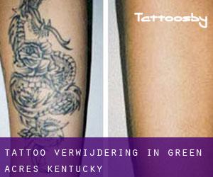 Tattoo verwijdering in Green Acres (Kentucky)