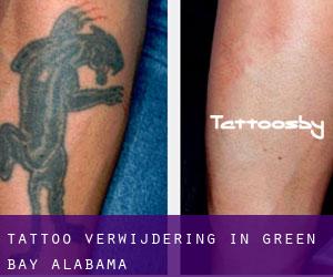 Tattoo verwijdering in Green Bay (Alabama)
