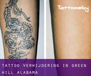 Tattoo verwijdering in Green Hill (Alabama)