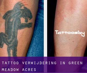 Tattoo verwijdering in Green Meadow Acres