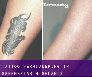 Tattoo verwijdering in Greenbriar Highlands