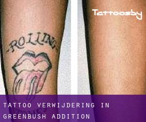 Tattoo verwijdering in Greenbush Addition