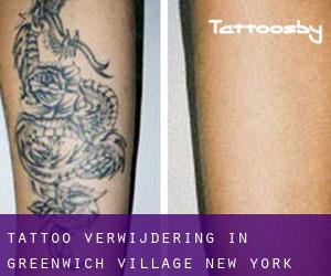 Tattoo verwijdering in Greenwich Village (New York)