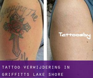 Tattoo verwijdering in Griffitts Lake Shore Subdivision