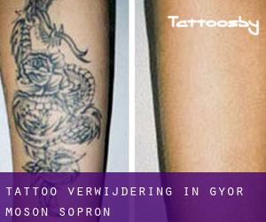 Tattoo verwijdering in Győr-Moson-Sopron