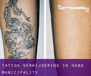 Tattoo verwijdering in Habo Municipality