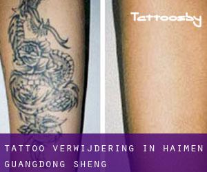 Tattoo verwijdering in Haimen (Guangdong Sheng)