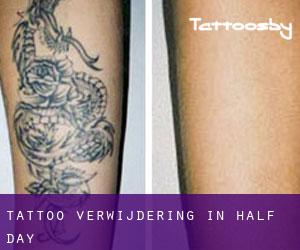 Tattoo verwijdering in Half Day