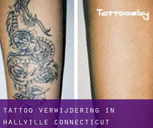 Tattoo verwijdering in Hallville (Connecticut)