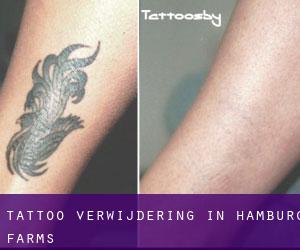 Tattoo verwijdering in Hamburg Farms