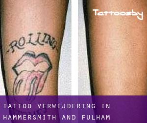 Tattoo verwijdering in Hammersmith and Fulham