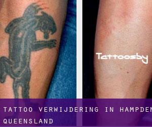Tattoo verwijdering in Hampden (Queensland)