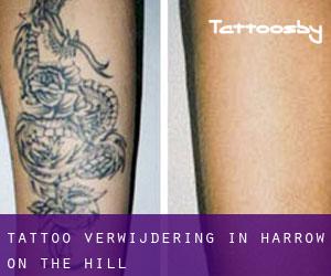 Tattoo verwijdering in Harrow on the Hill