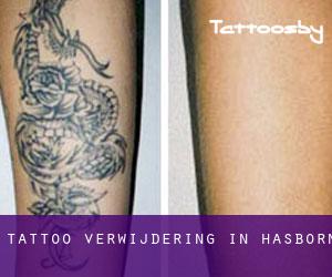 Tattoo verwijdering in Hasborn