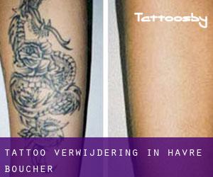 Tattoo verwijdering in Havre Boucher
