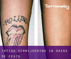Tattoo verwijdering in Hazas de Cesto