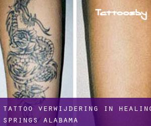 Tattoo verwijdering in Healing Springs (Alabama)