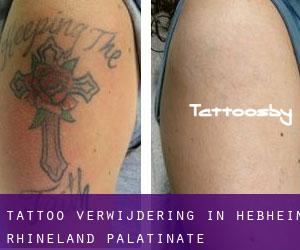 Tattoo verwijdering in Heßheim (Rhineland-Palatinate)