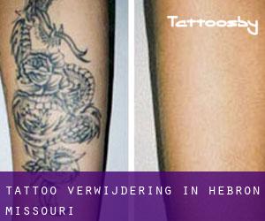 Tattoo verwijdering in Hebron (Missouri)