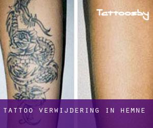 Tattoo verwijdering in Hemne