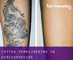 Tattoo verwijdering in Herefordshire