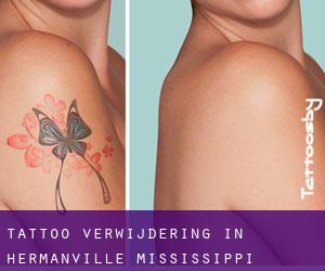 Tattoo verwijdering in Hermanville (Mississippi)