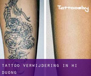 Tattoo verwijdering in Hải Dương