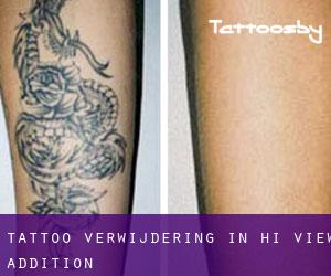 Tattoo verwijdering in Hi-View Addition
