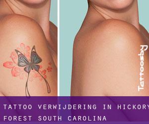 Tattoo verwijdering in Hickory Forest (South Carolina)