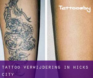 Tattoo verwijdering in Hicks City