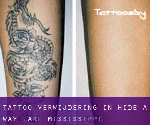 Tattoo verwijdering in Hide-A-Way Lake (Mississippi)