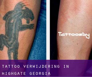 Tattoo verwijdering in Highgate (Georgia)