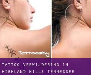 Tattoo verwijdering in Highland Hills (Tennessee)