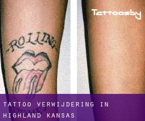Tattoo verwijdering in Highland (Kansas)