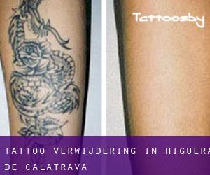 Tattoo verwijdering in Higuera de Calatrava