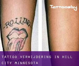 Tattoo verwijdering in Hill City (Minnesota)